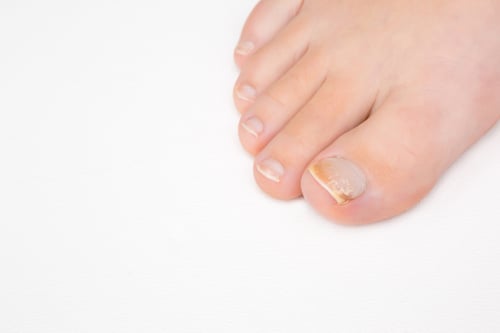 A foot with toenail fungus. 