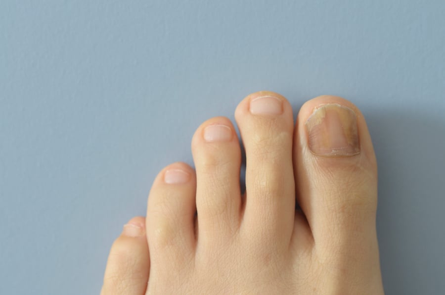 Yellow toenails on foot with blue background