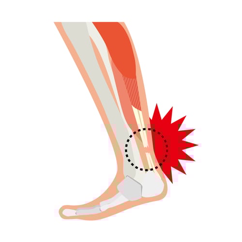Graphic of Achilles Tendon