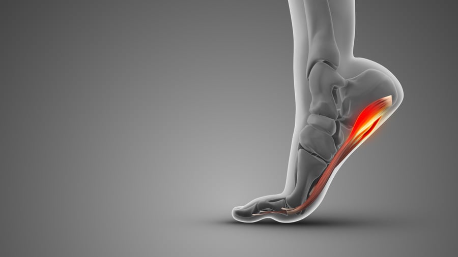 Plantar Fasciitis medical concept