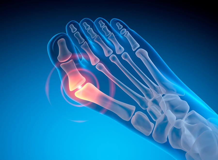 X ray 3D illustration of bunion with blue background