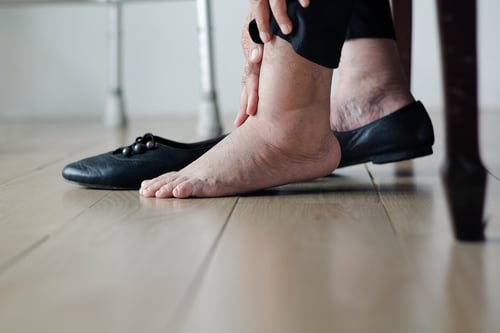 Elderly woman with swollen feet putting on shoes